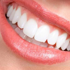 Teeth with porcelain veneers